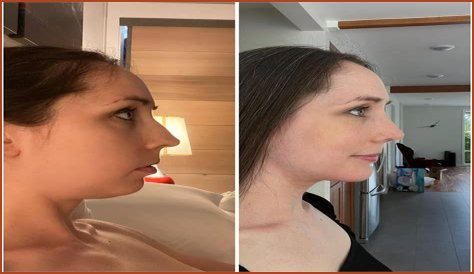 Iggy Azalea recently had a nose job & chin implant, says an Iggy source